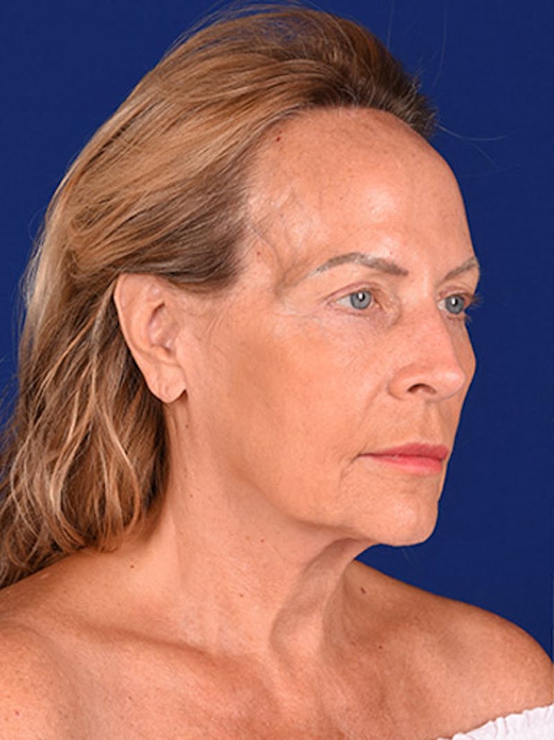 Facelift Before & After Gallery - Patient 10678690 - Image 3