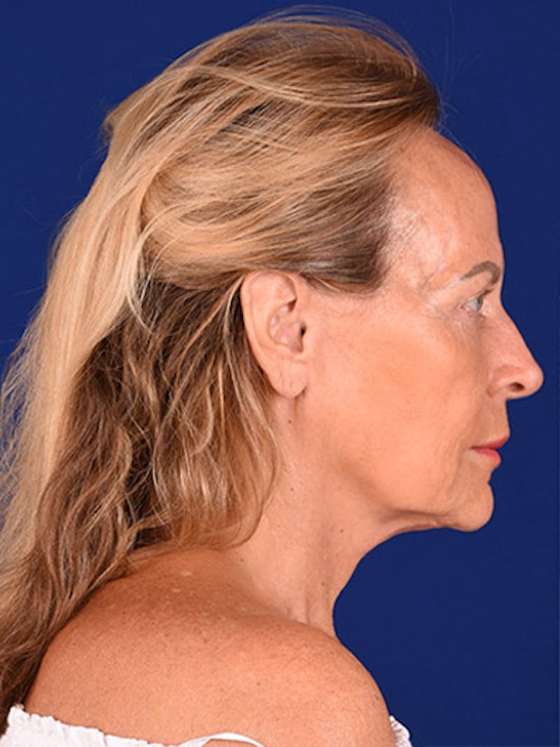 Facelift Before & After Gallery - Patient 10678690 - Image 5