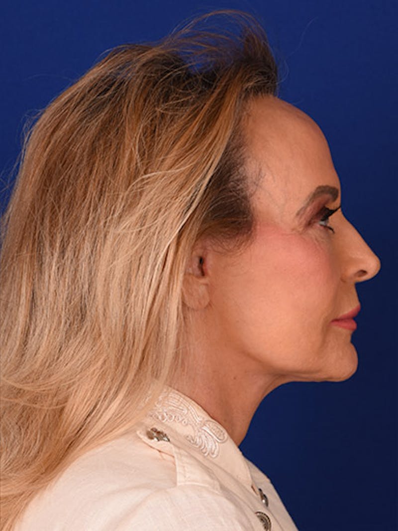 Facelift Before & After Gallery - Patient 10678690 - Image 6