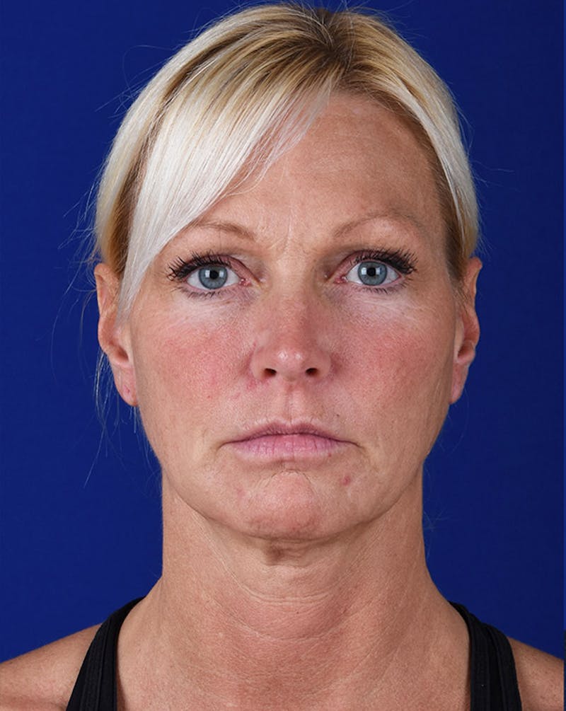 Facelift Before & After Gallery - Patient 10678691 - Image 1