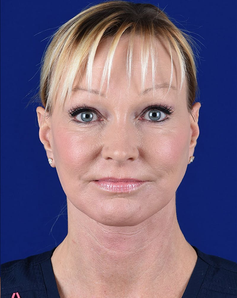 Facelift Before & After Gallery - Patient 10678691 - Image 2