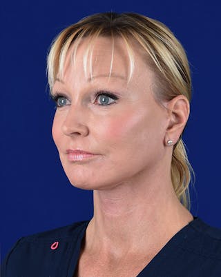 Facelift Before & After Gallery - Patient 10678691 - Image 4