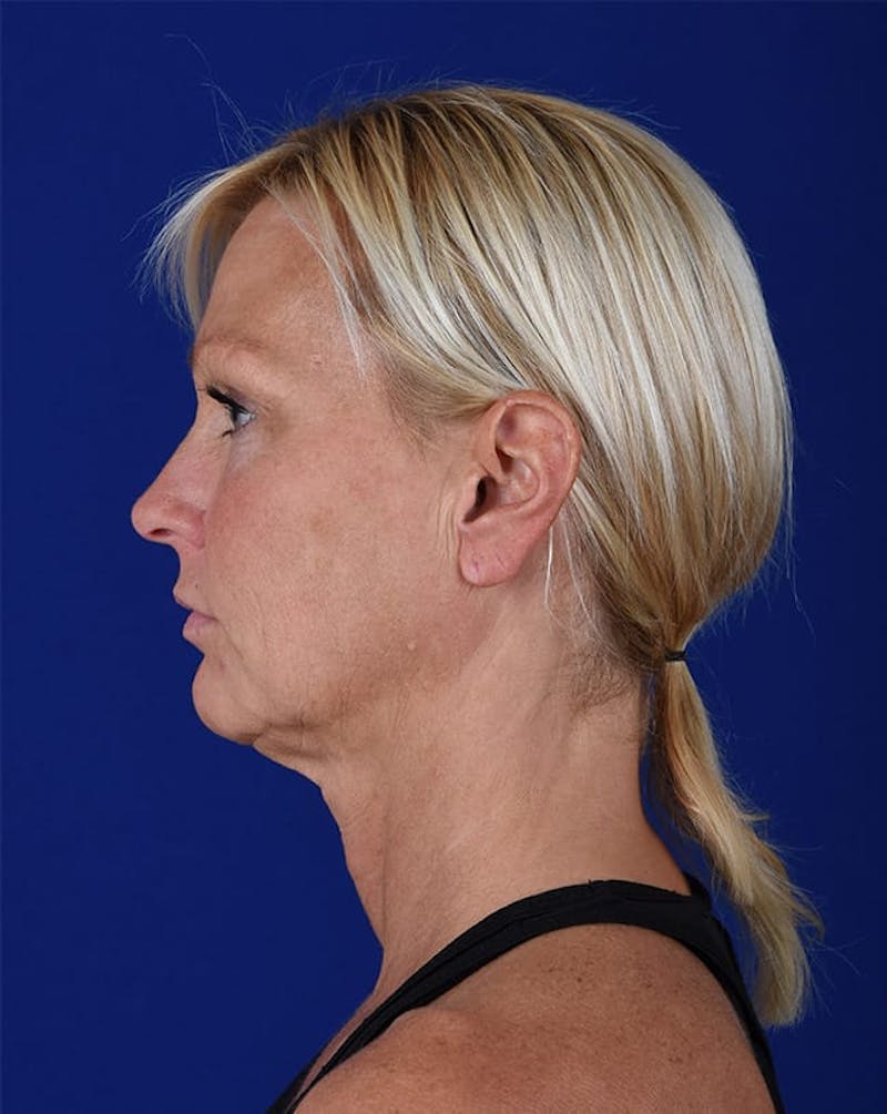 Facelift Before & After Gallery - Patient 10678691 - Image 5