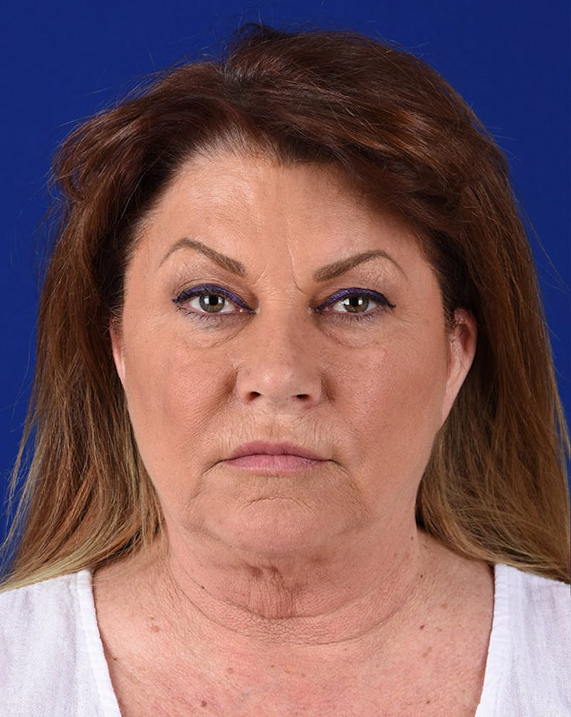 Facelift Before & After Gallery - Patient 10678692 - Image 1