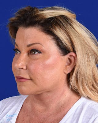 Facelift Before & After Gallery - Patient 10678692 - Image 4