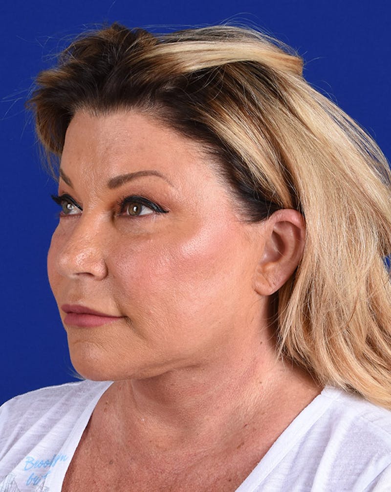 Facelift Before & After Gallery - Patient 10678692 - Image 4