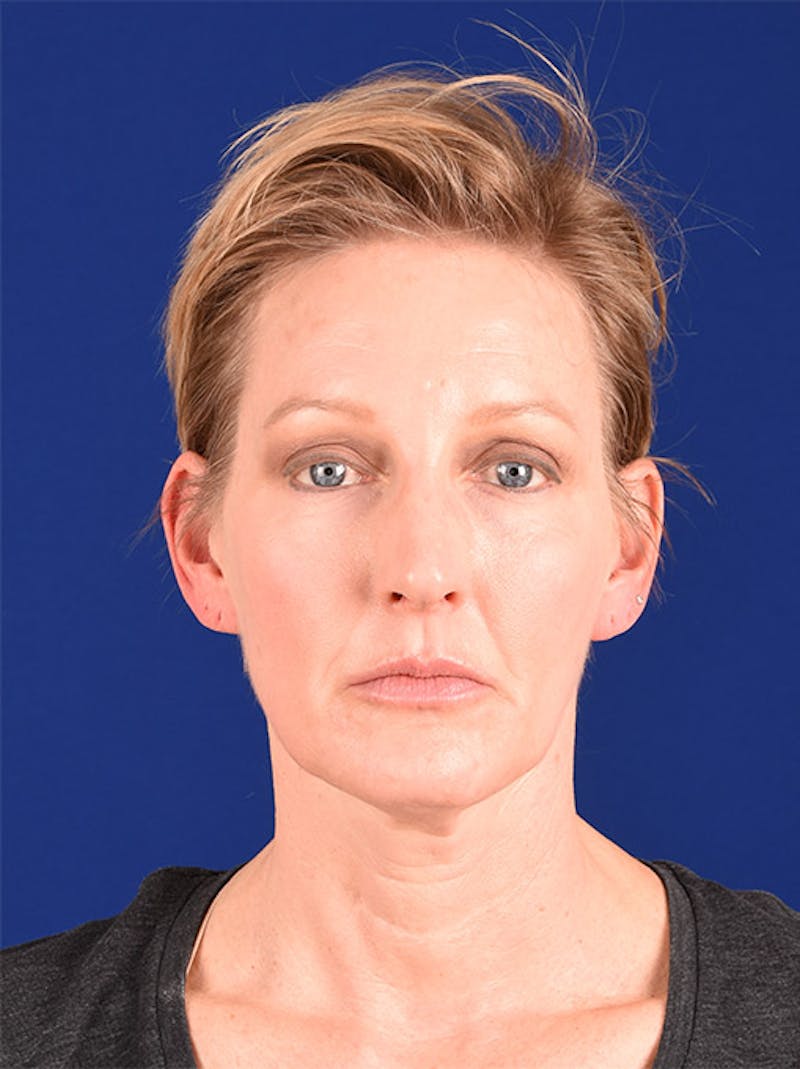 Facelift Before & After Gallery - Patient 10678693 - Image 1