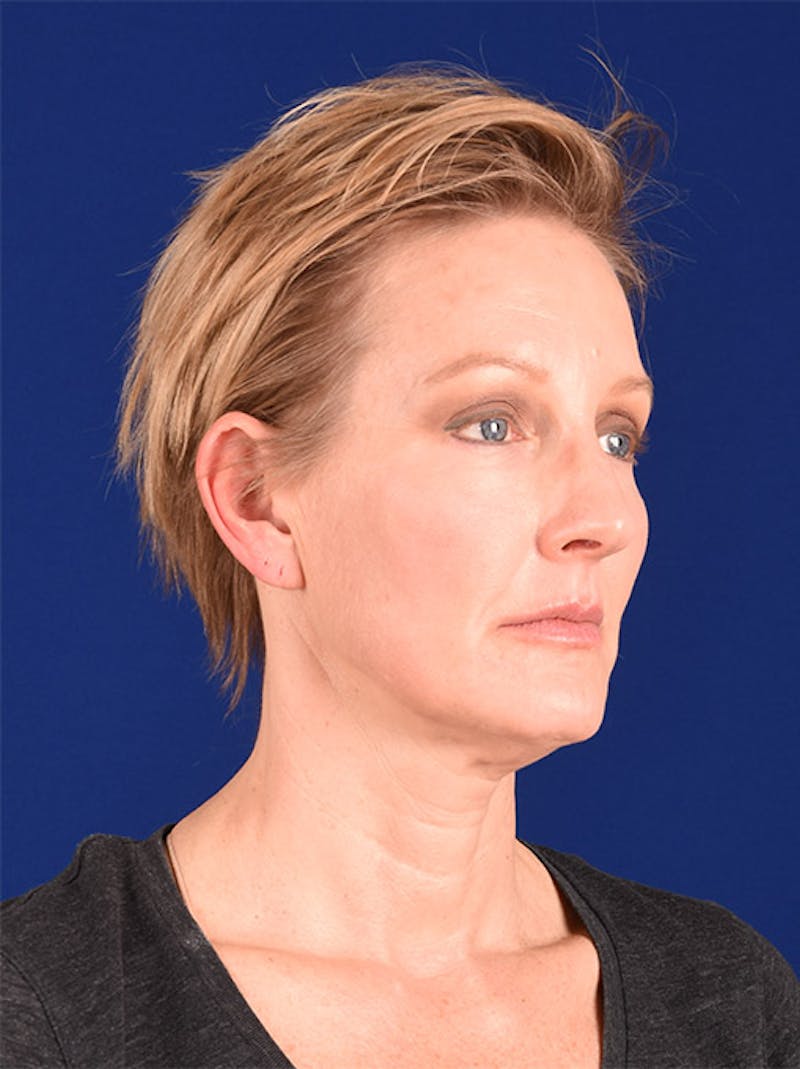 Facelift Before & After Gallery - Patient 10678693 - Image 3