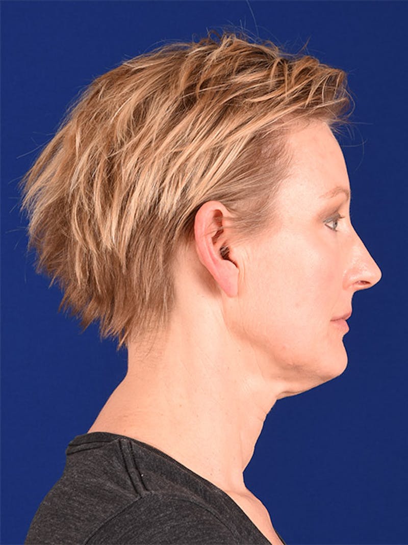 Facelift Before & After Gallery - Patient 10678693 - Image 5