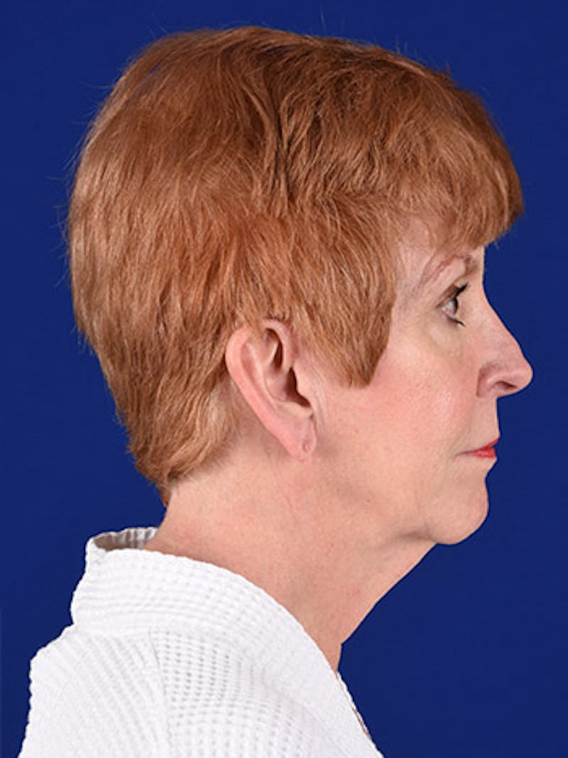 Facelift Before & After Gallery - Patient 10678694 - Image 5