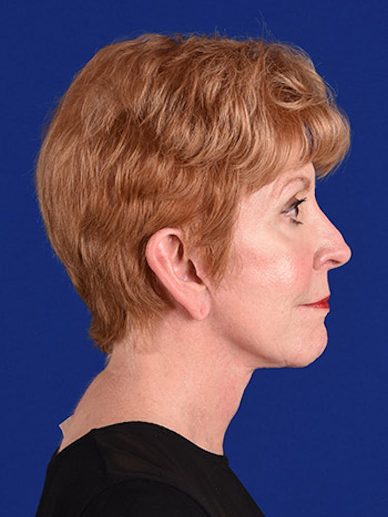 Facelift Before & After Gallery - Patient 10678694 - Image 6