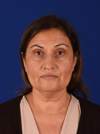 Facelift Before & After Gallery - Patient 10678696 - Image 1