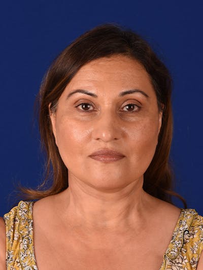 Facelift Before & After Gallery - Patient 10678696 - Image 2