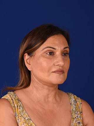 Facelift Before & After Gallery - Patient 10678696 - Image 4