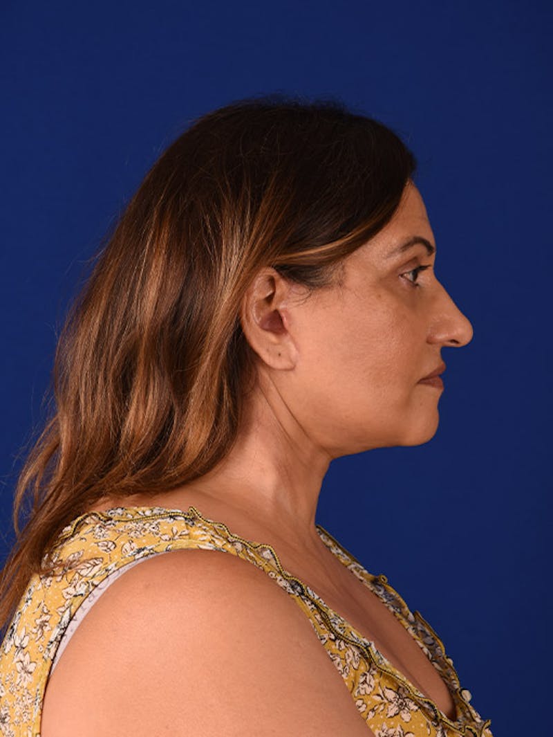 Facelift Before & After Gallery - Patient 10678696 - Image 6