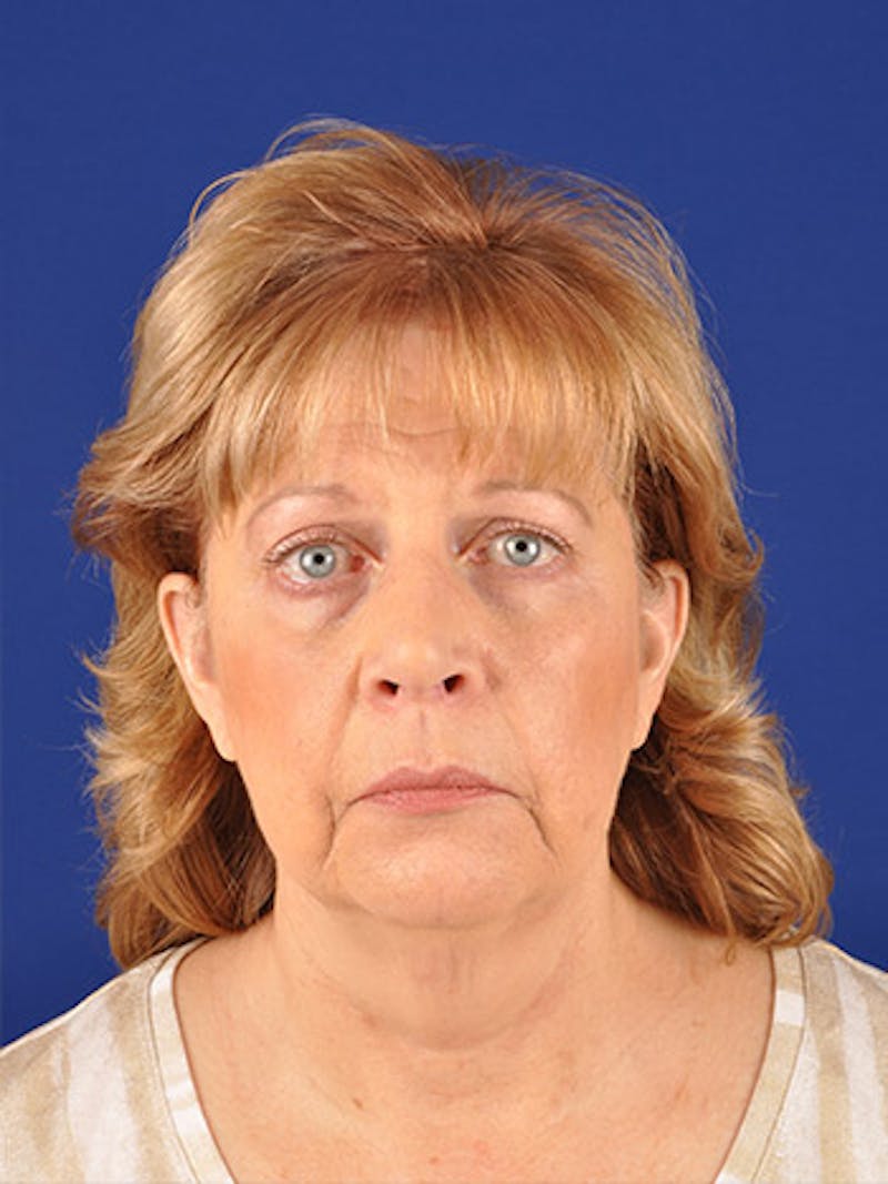 Facelift Before & After Gallery - Patient 10678698 - Image 1
