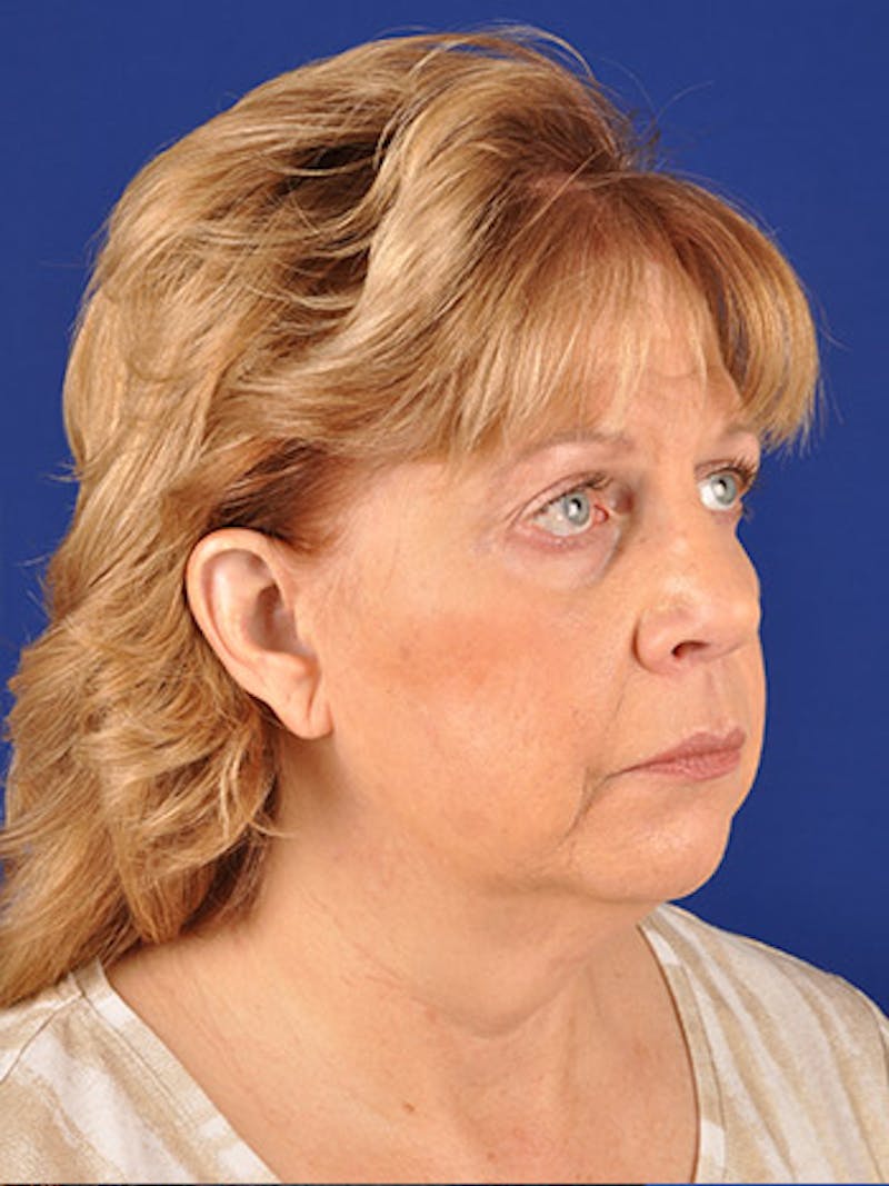 Facelift Before & After Gallery - Patient 10678698 - Image 3