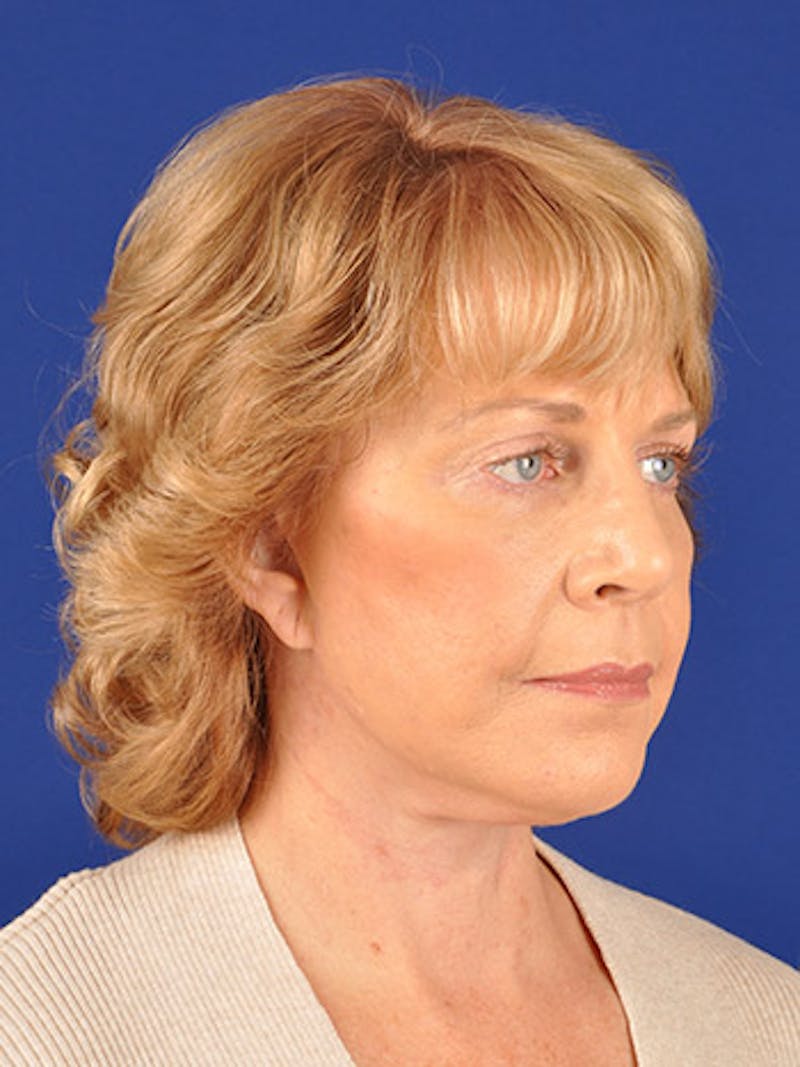 Facelift Before & After Gallery - Patient 10678698 - Image 4