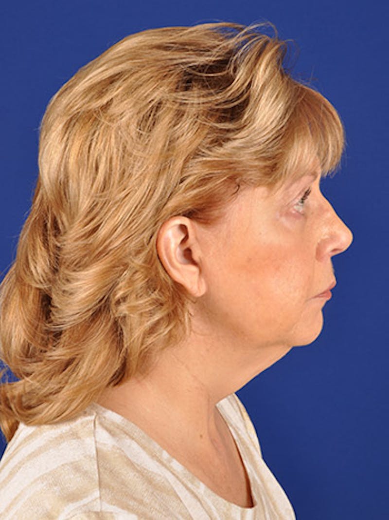 Facelift Before & After Gallery - Patient 10678698 - Image 5