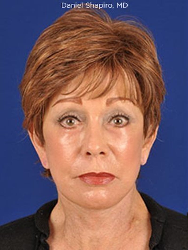 Facelift Before & After Gallery - Patient 10678699 - Image 2