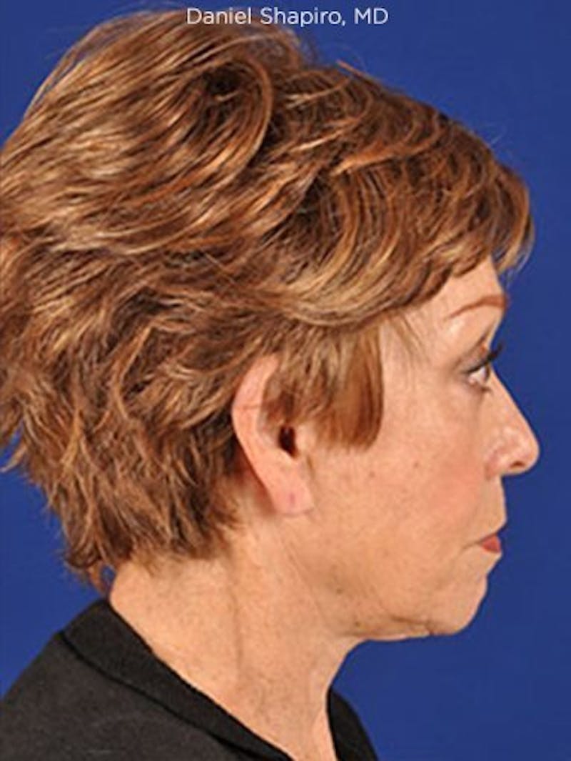 Facelift Before & After Gallery - Patient 10678699 - Image 3