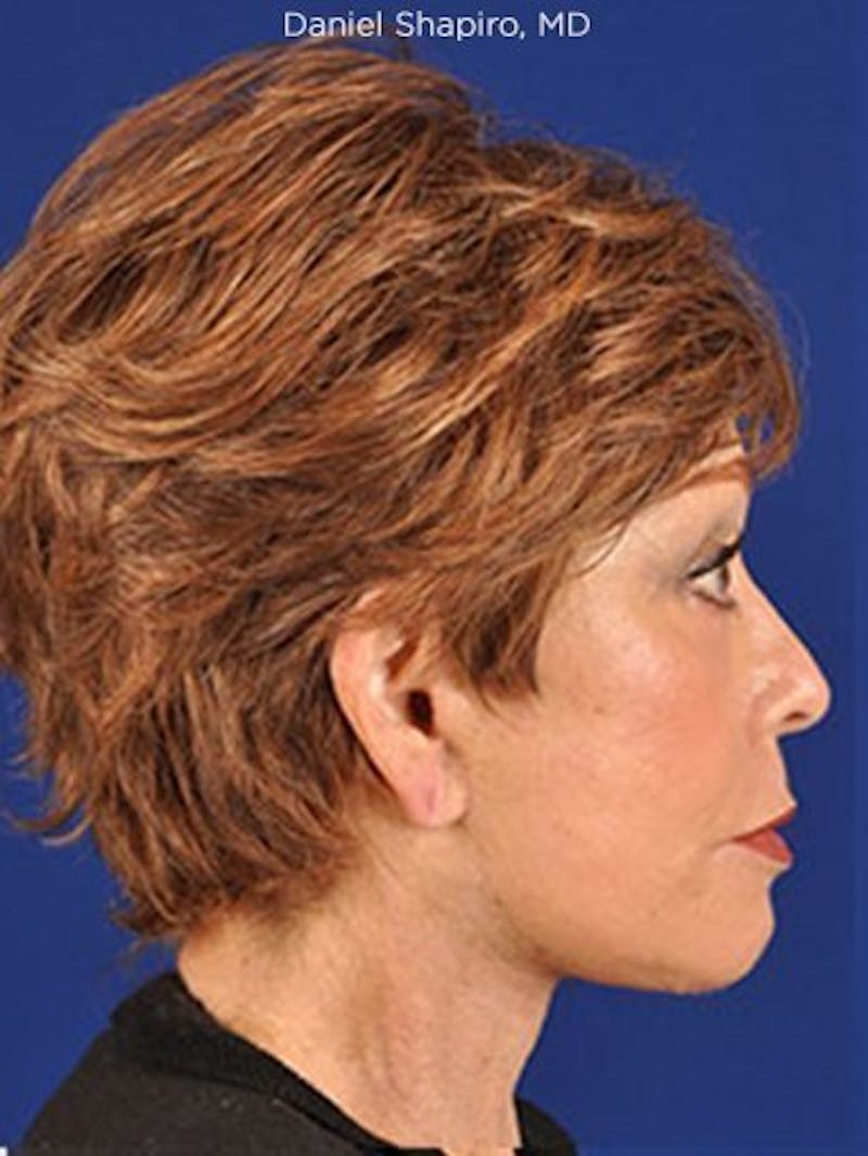 Facelift Before & After Gallery - Patient 10678699 - Image 4