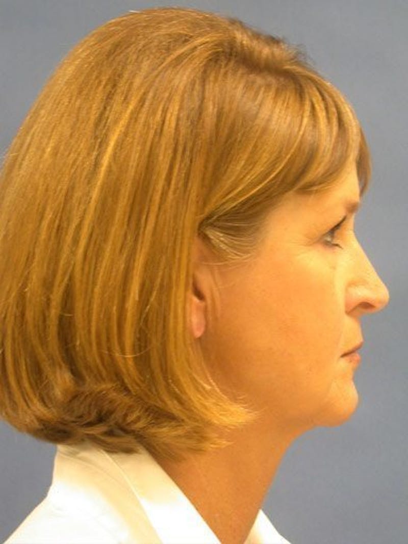 Facelift Before & After Gallery - Patient 10678702 - Image 3