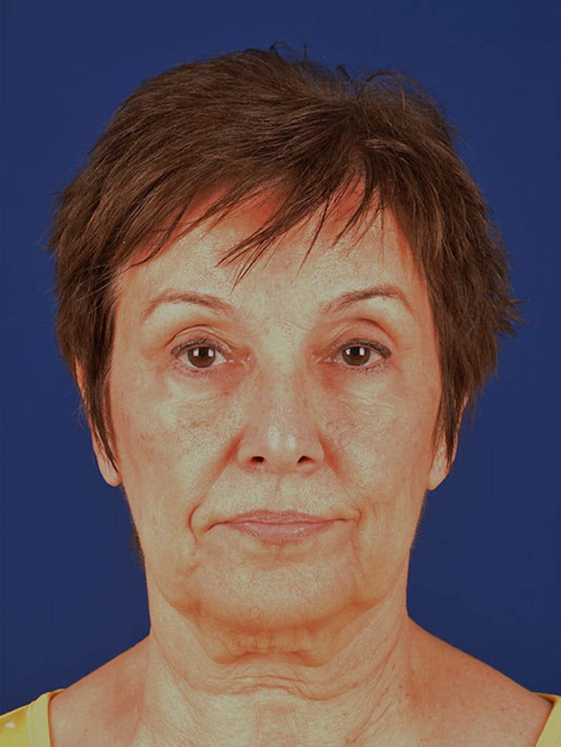 Facelift Before & After Gallery - Patient 10678703 - Image 1