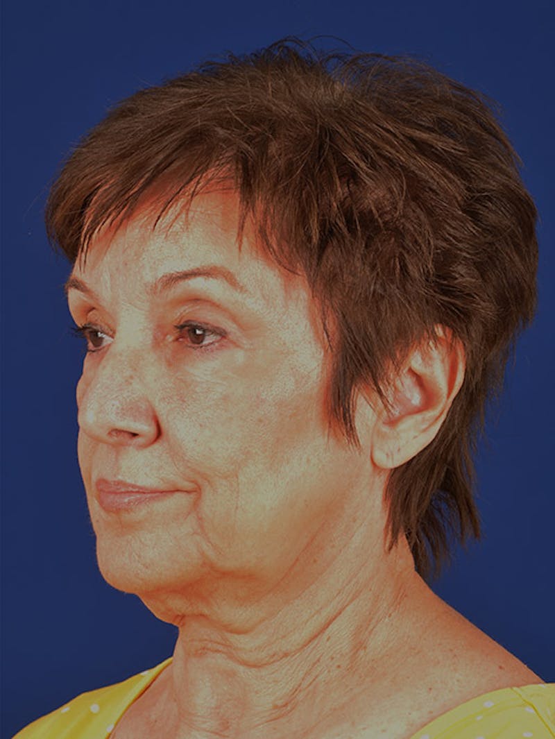 Facelift Before & After Gallery - Patient 10678703 - Image 3