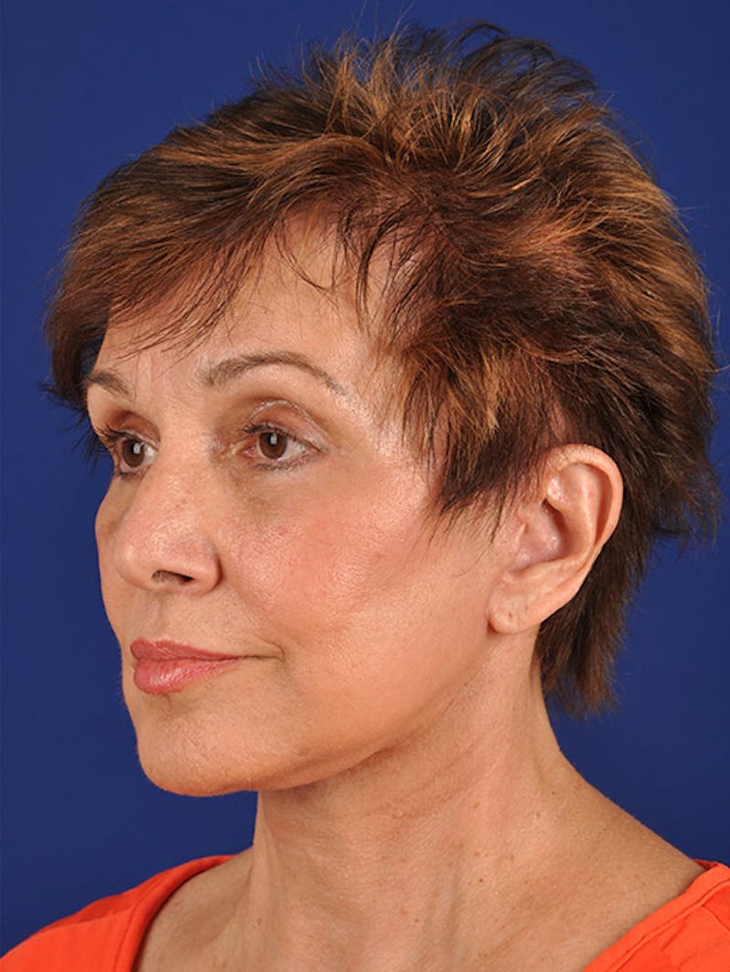 Facelift Before & After Gallery - Patient 10678703 - Image 4
