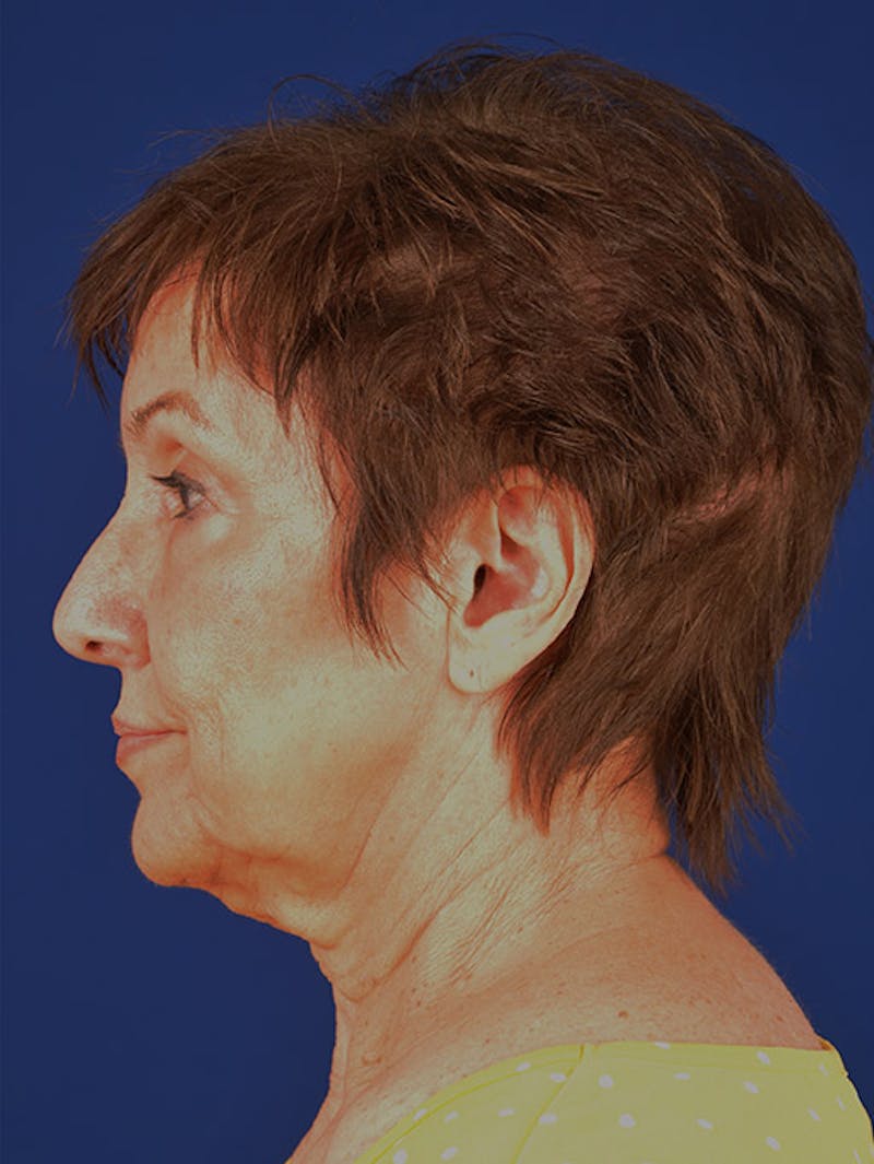 Facelift Before & After Gallery - Patient 10678703 - Image 5