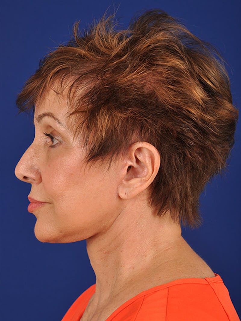 Facelift Before & After Gallery - Patient 10678703 - Image 6