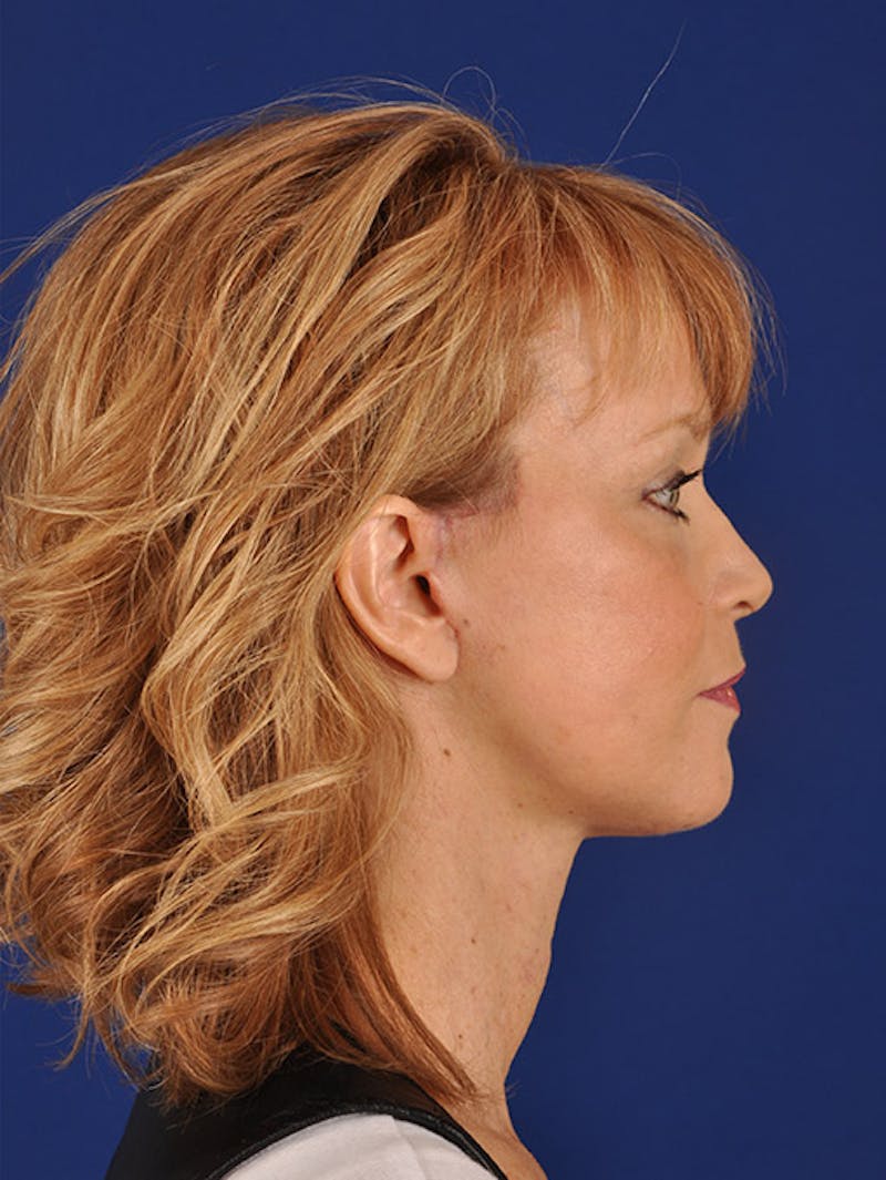 Facelift Before & After Gallery - Patient 10678704 - Image 6