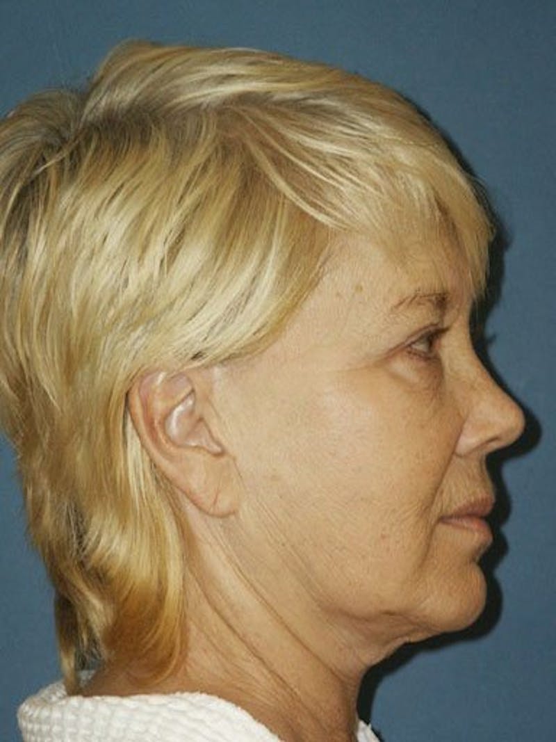 Facelift Before & After Gallery - Patient 10678705 - Image 3