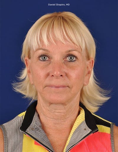 Facelift Before & After Gallery - Patient 10974300 - Image 1