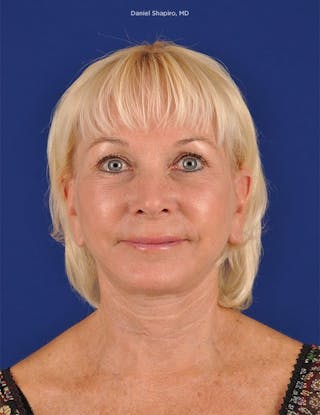 Facelift Before & After Gallery - Patient 10974300 - Image 2
