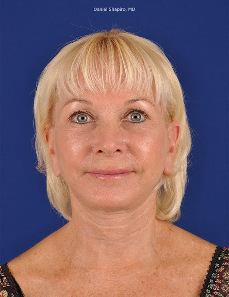 Facelift Before & After Gallery - Patient 10974300 - Image 2