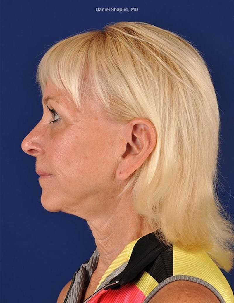 Facelift Before & After Gallery - Patient 10974300 - Image 5