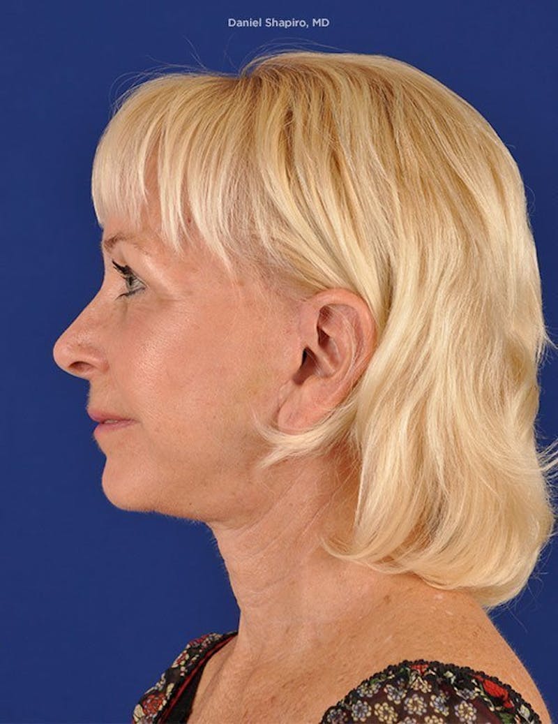 Facelift Before & After Gallery - Patient 10974300 - Image 6