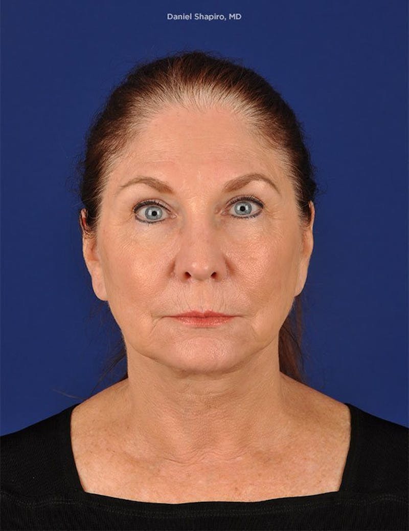 Facelift Before & After Gallery - Patient 10974302 - Image 1