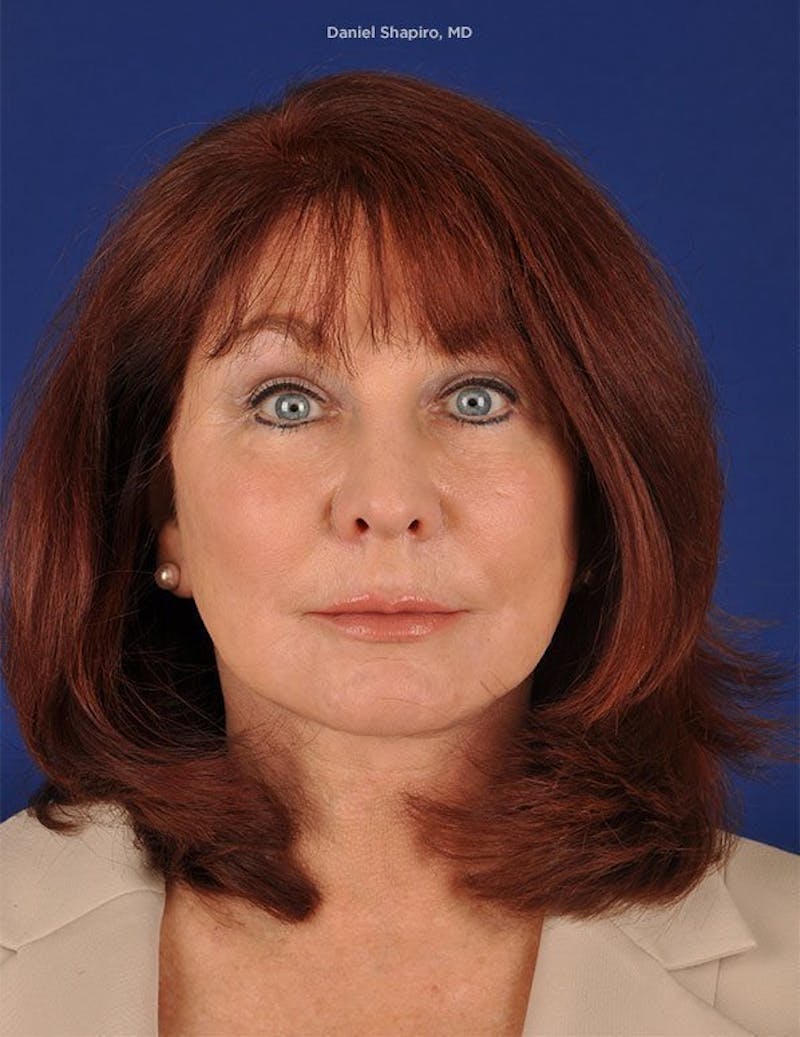 Facelift Before & After Gallery - Patient 10974302 - Image 2