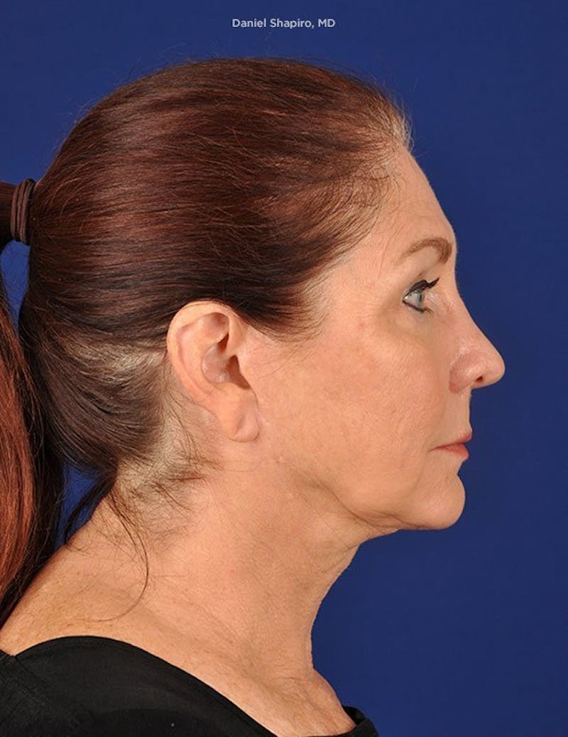 Facelift Before & After Gallery - Patient 10974302 - Image 5