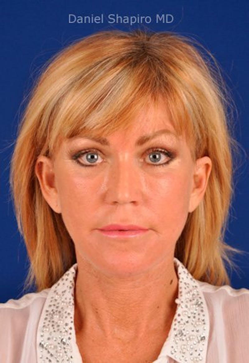 Facelift Before & After Gallery - Patient 10974303 - Image 2