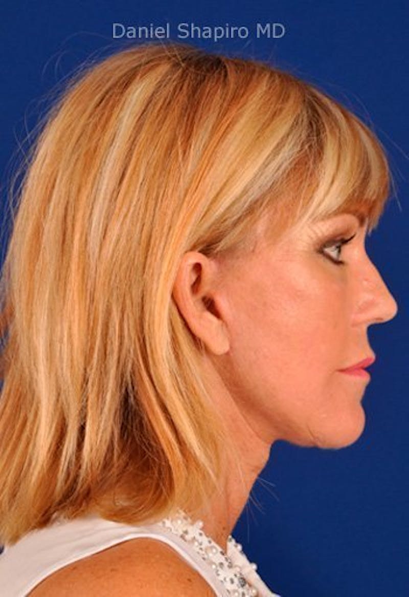 Facelift Before & After Gallery - Patient 10974303 - Image 6