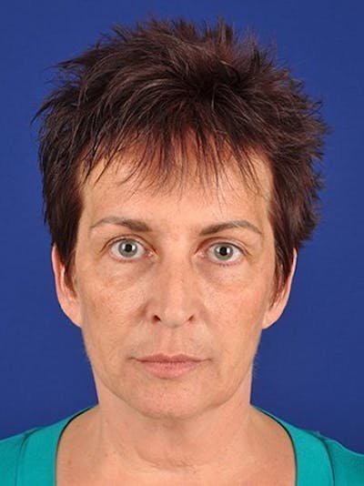 Facelift Before & After Gallery - Patient 10974305 - Image 1