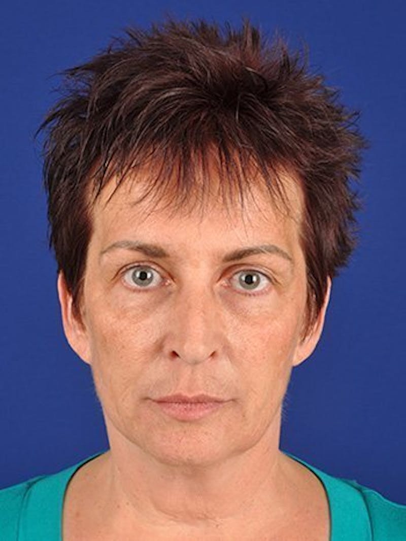 Facelift Before & After Gallery - Patient 10974305 - Image 1