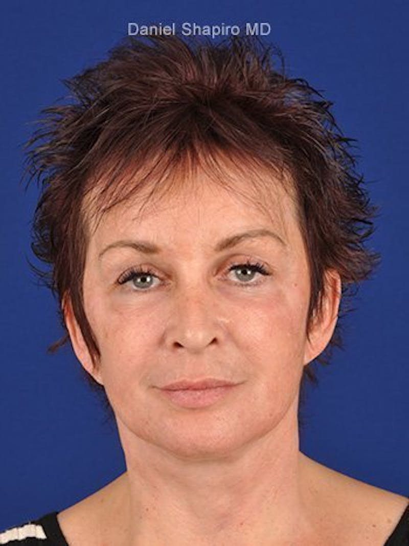 Facelift Before & After Gallery - Patient 10974305 - Image 2