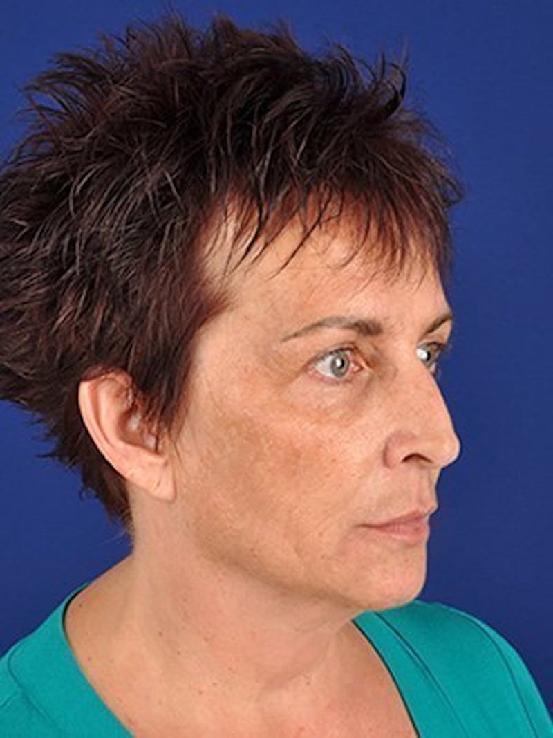Facelift Before & After Gallery - Patient 10974305 - Image 3