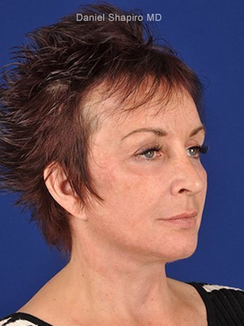 Facelift Before & After Gallery - Patient 10974305 - Image 4