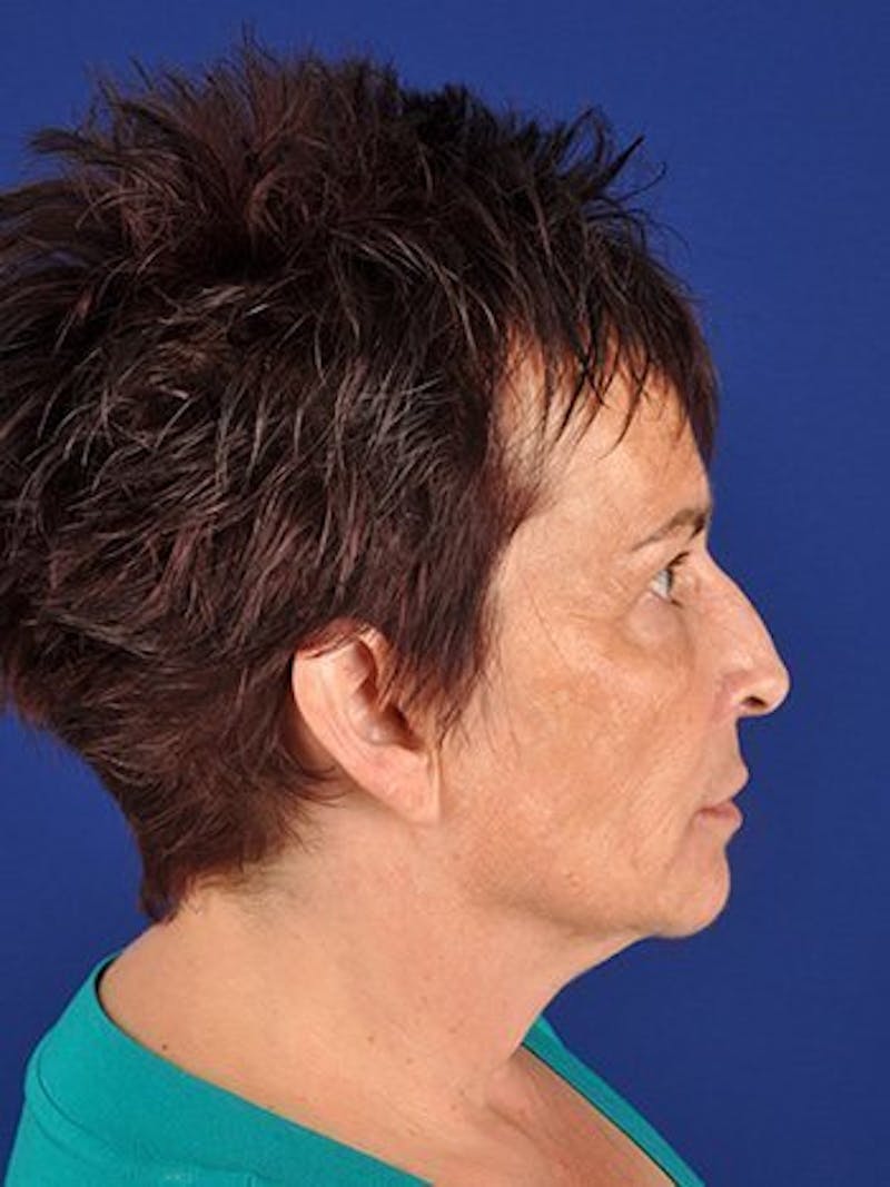 Facelift Before & After Gallery - Patient 10974305 - Image 5